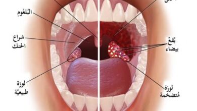 أسباب وأعراض التهاب الحلق