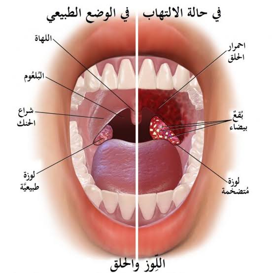 أسباب وأعراض التهاب الحلق