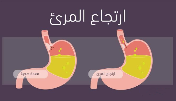 الفرق بين المعدة الصحية و ارتجاع المريء