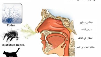 أسباب وأعراض حساسية الأنف