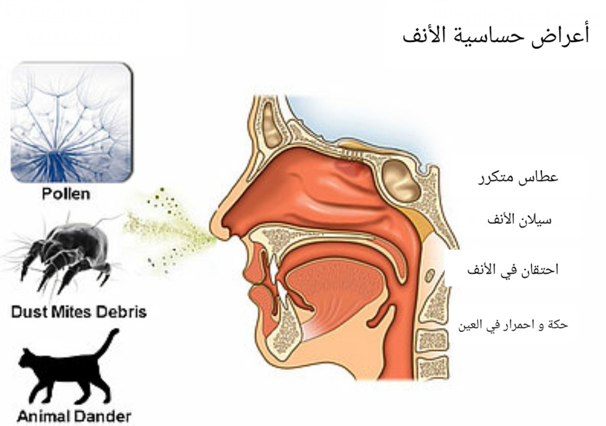 أسباب وأعراض حساسية الأنف