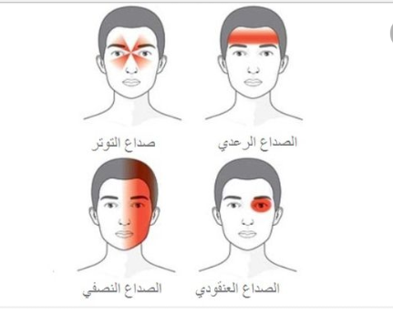 أماكن الصداع النصفي وكيفية التعامل معها