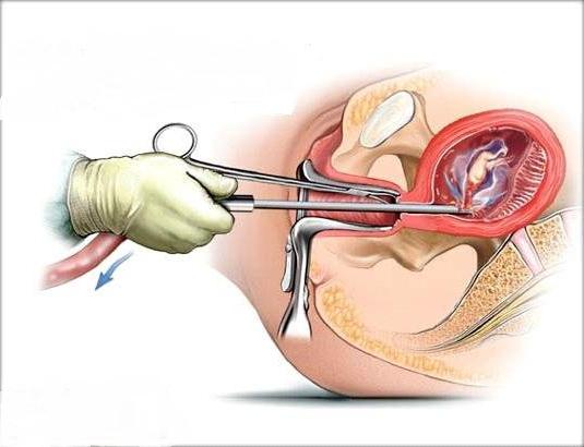 طرق الإجهاض