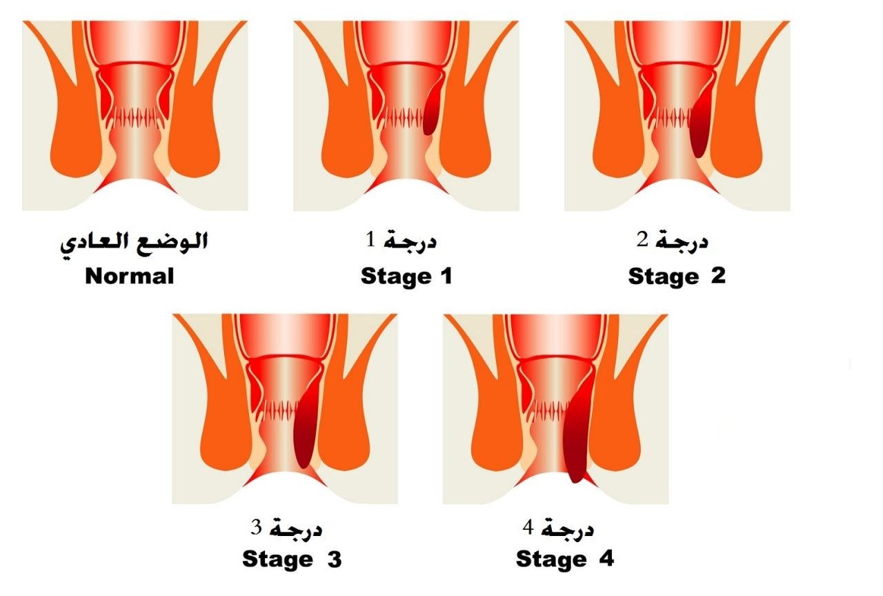 مراحل وأنواع وأعراض البواسير والشرخ الشرجي