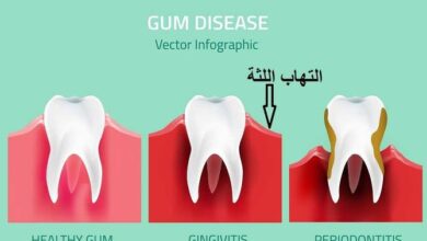 أسباب وأعراض التهابات اللثة