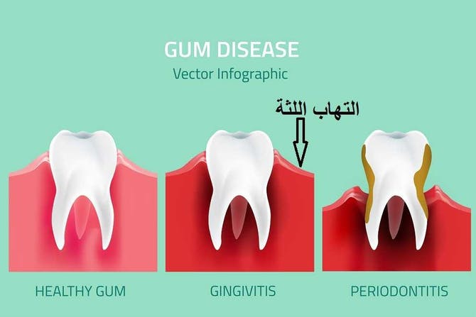 أسباب وأعراض التهابات اللثة