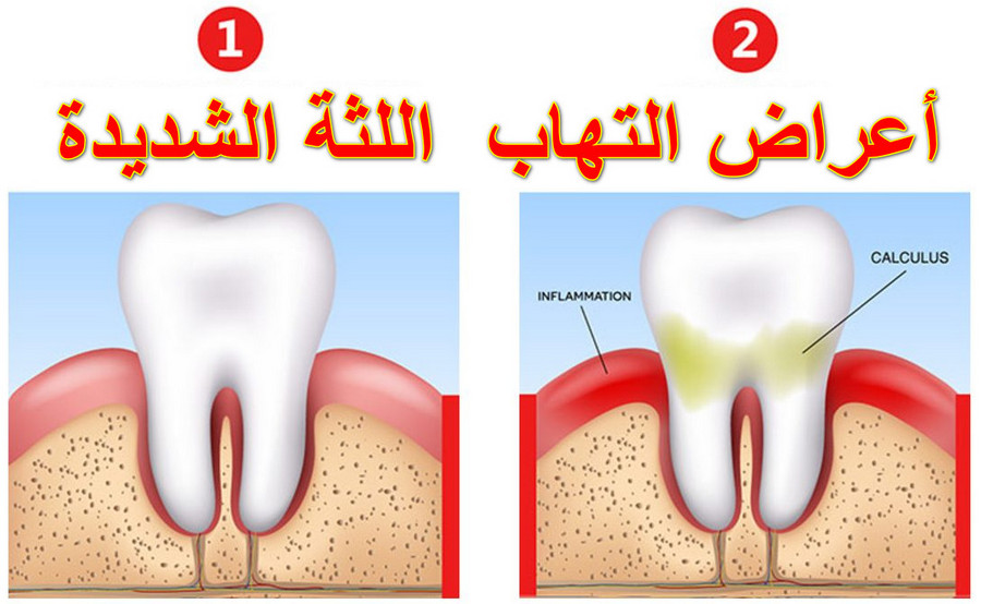 أسباب وأعراض التهابات اللثة