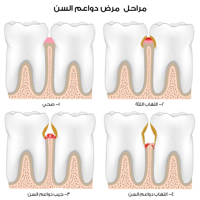 أسباب وأعراض التهابات اللثة