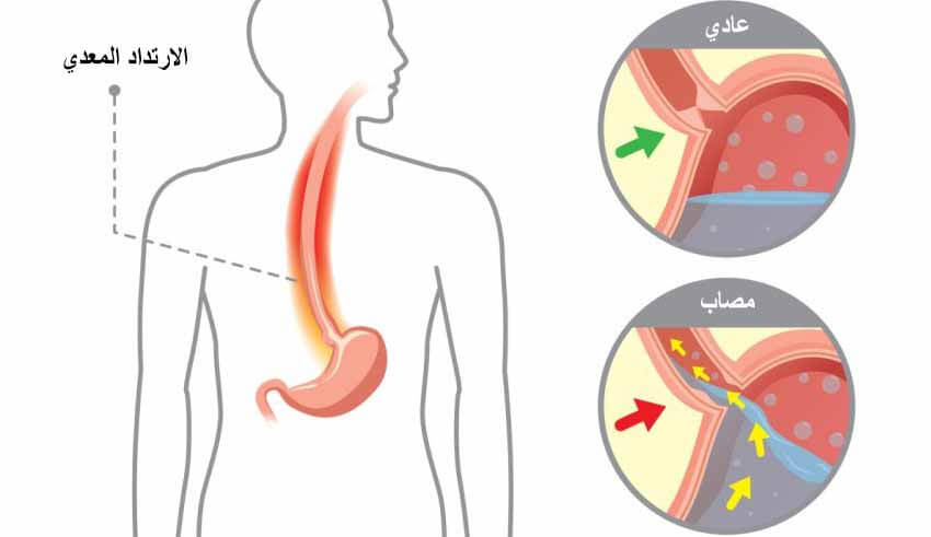 علاج ارتجاع المريء