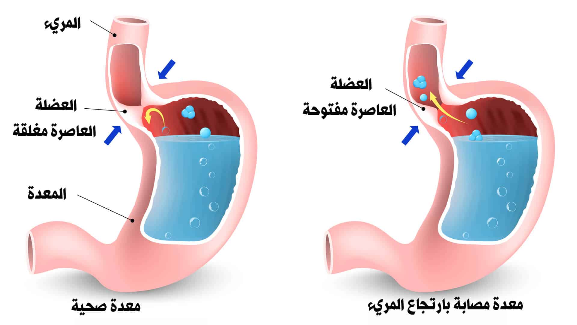 علاج ارتجاع المريء