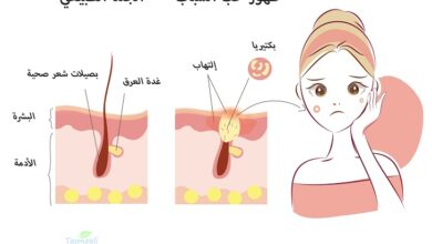 أنواع وأماكن توزيع حب الشباب