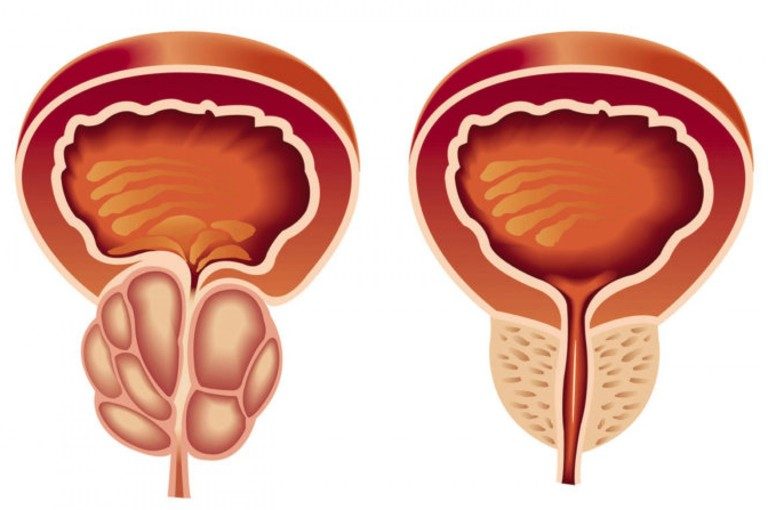أسباب وأعراض احتقان البروستاتا
