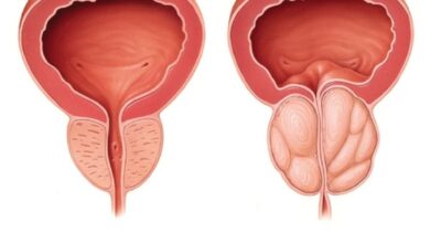 أسباب وأعراض احتقان البروستاتا