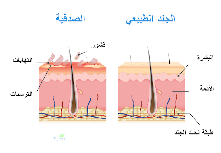 أسباب وأعراض الصدفية