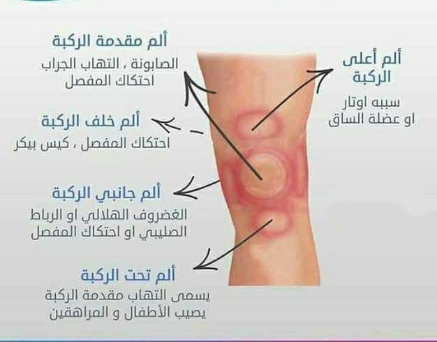 علاج آلام الركبة