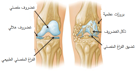 أسباب وأعراض خشونة الركبة وكيفية علاجها