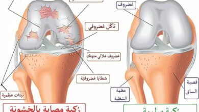 كيفية علاج أعراض خشونة الركبة