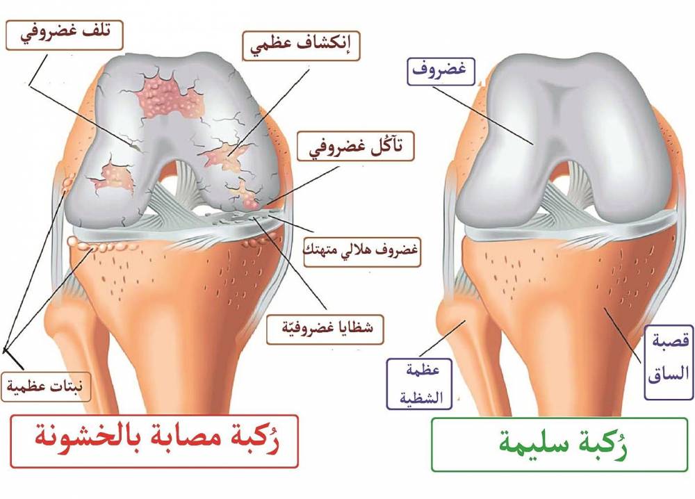 كيفية علاج أعراض خشونة الركبة