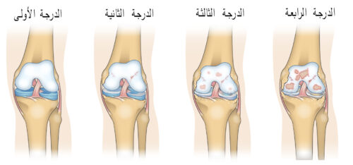 كيفية علاج أعراض خشونة الركبة