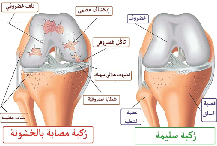 أعراض ومراحل خشونة الركبة وكيفية علاجها