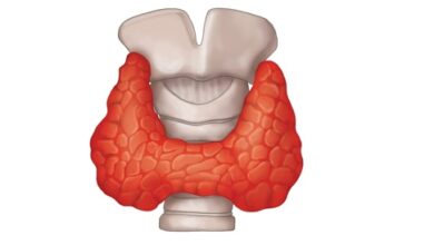 كيفية علاج أعراض فرط نشاط الغدة الدرقية
