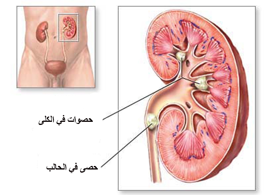 علاج حصوات الحالب