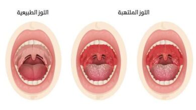 كيفية علاج أعراض التهاب اللوزتين