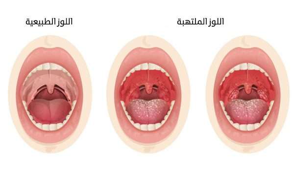 كيفية علاج أعراض التهاب اللوزتين