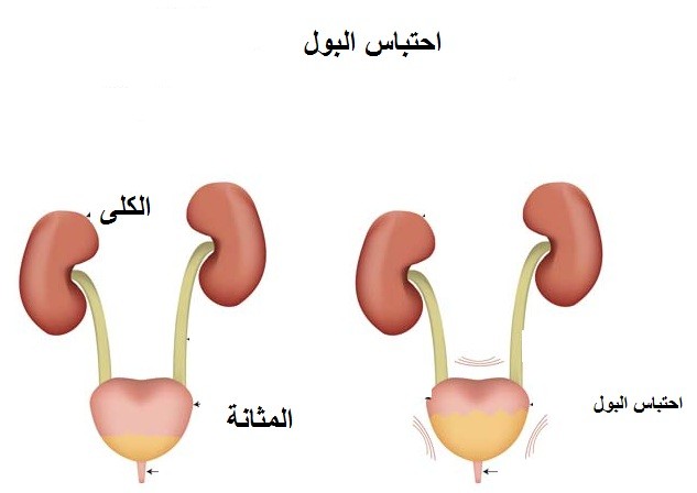 أدوية علاج أعراض احتباس البول