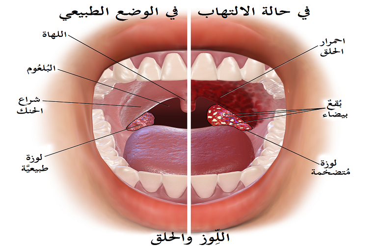 كيفية علاج أعراض التهاب اللوزتين