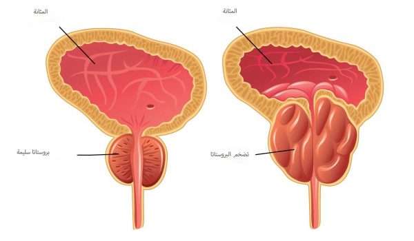 أدوية علاج أعراض احتباس البول