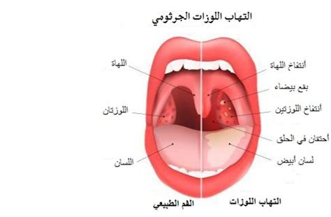 كيفية علاج التهاب الحلق