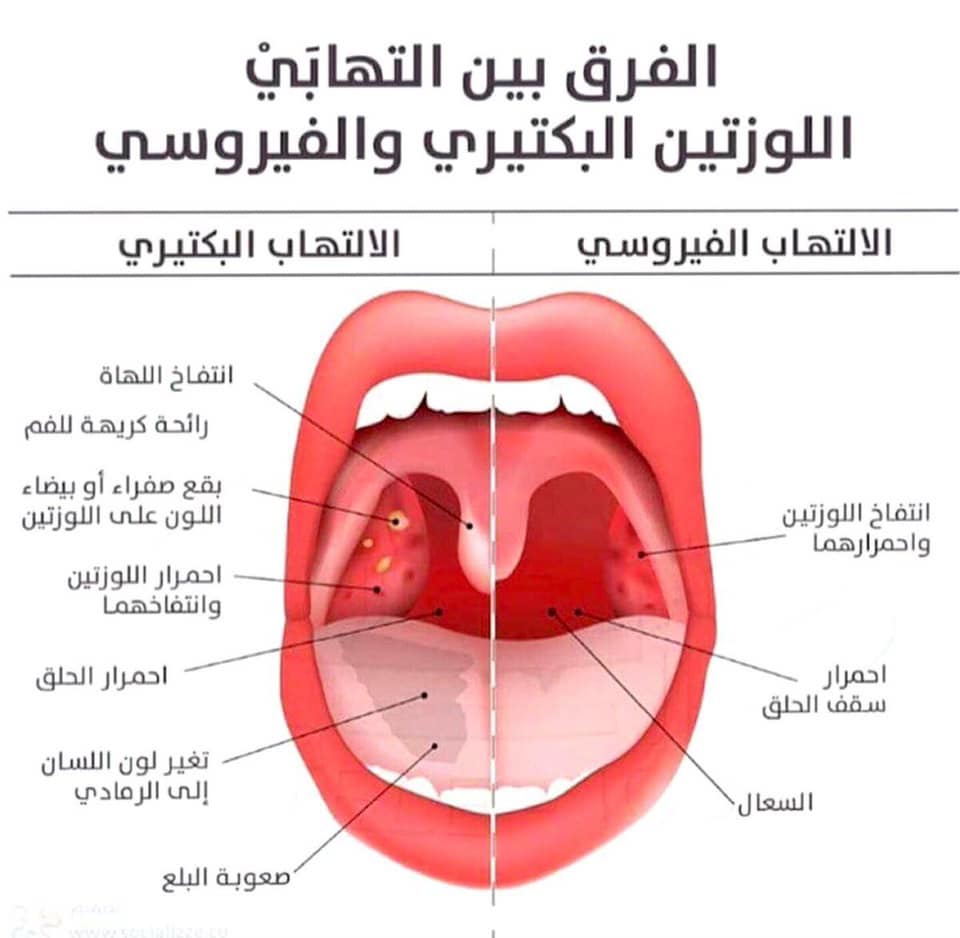 كيفية علاج التهاب الحلق