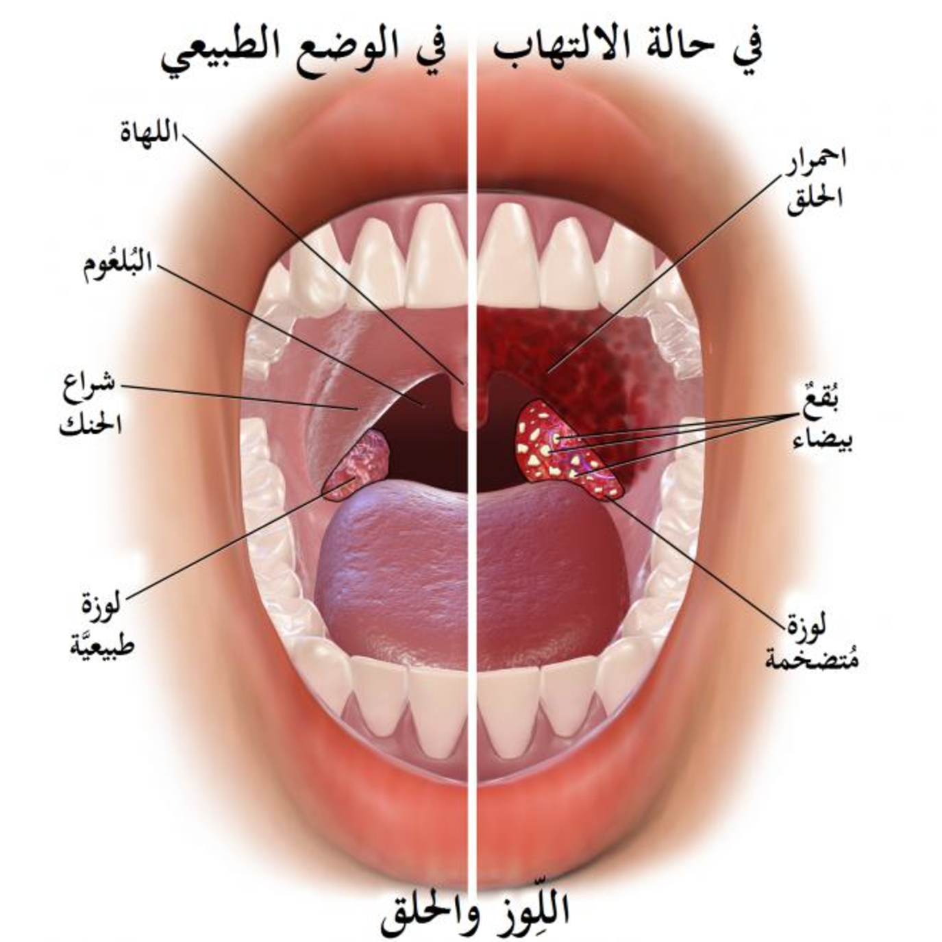 أعراض التهابات الحلق