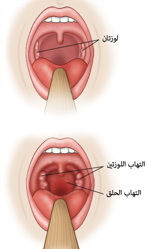 علاج التهابات الحلق