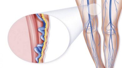 أعراض الدوالي وكيفية علاجها