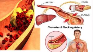 الأعراض الجانبية لحبوب الكوليسترول