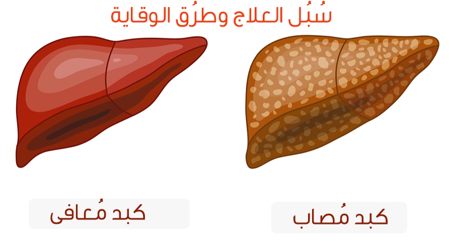 علاج دهون الكبد