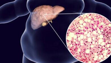 علاج دهون الكبد