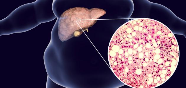 علاج دهون الكبد