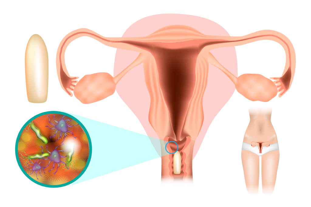 علاج الالتهابات المهبلية