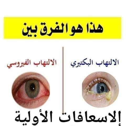 علاج أعراض التهاب العين