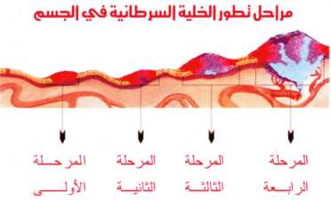 أنواع وأعراض ومراحل السرطان