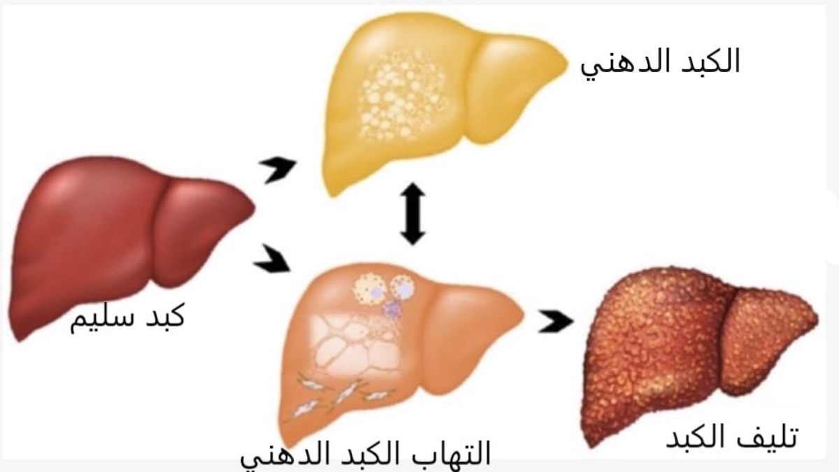 علاج دهون الكبد