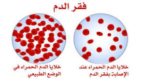 أفضل حبوب لعلاج فقر الدم