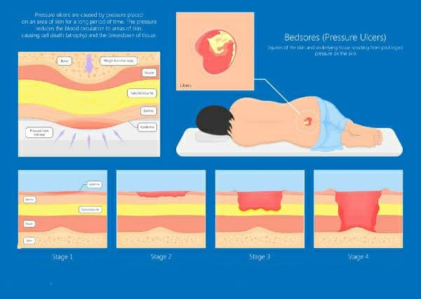 أسباب قرح الفراش وكيفية علاجها