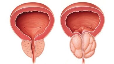 أفضل دواء لتضخم البروستاتا وعلاقته بالانتصاب