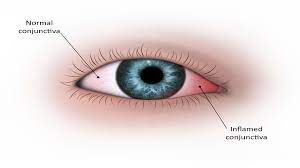 كيفية علاج حرقان العين