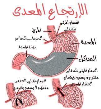 كيفية علاج أسباب وأعراض الحموضة وارتجاع المريء