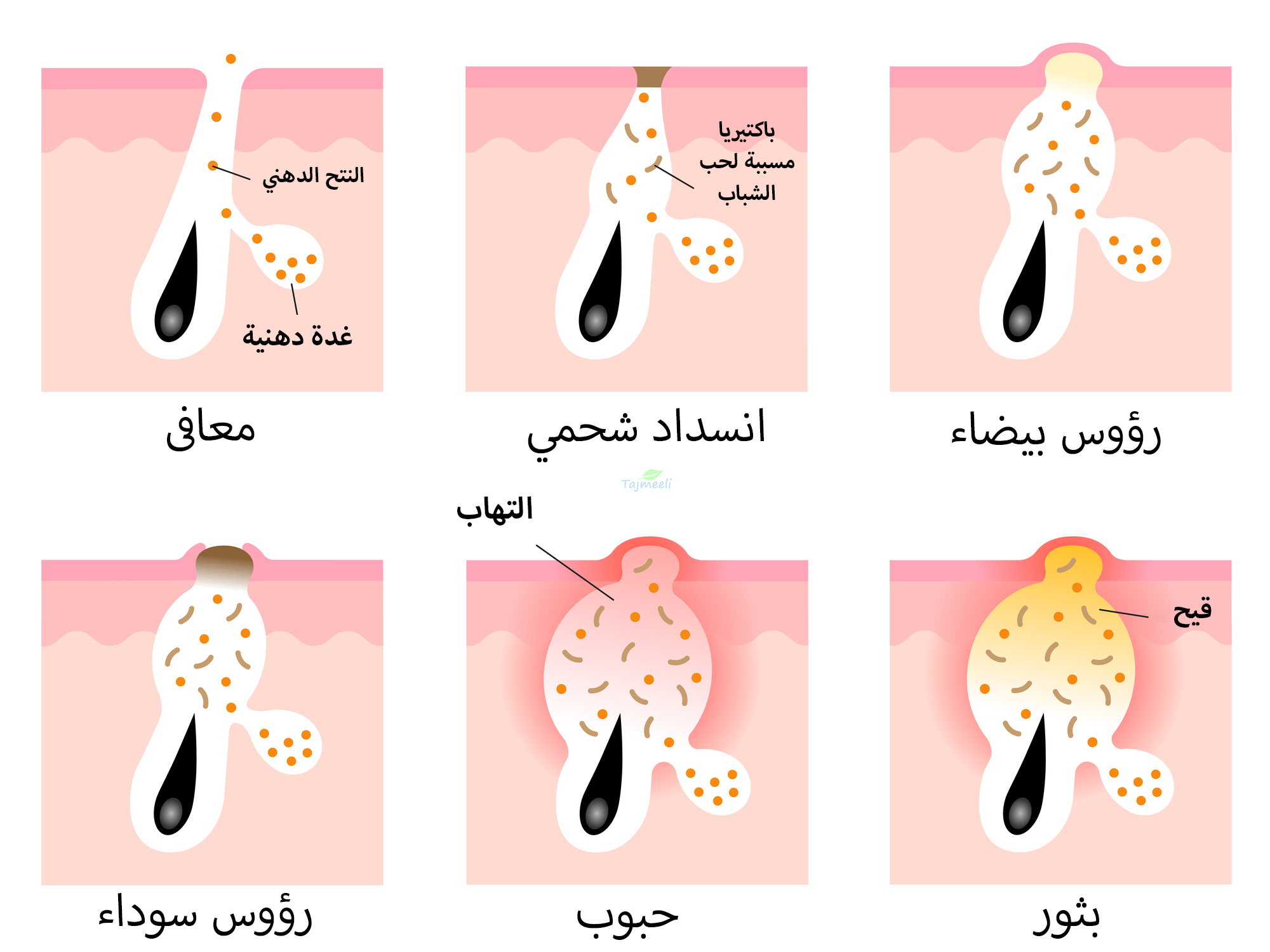 كيفية إزالة الرؤوس السوداء